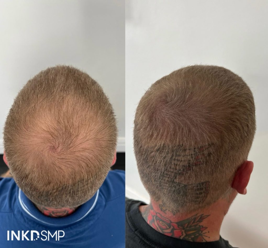 smp-hair-loss-tattoo-australia